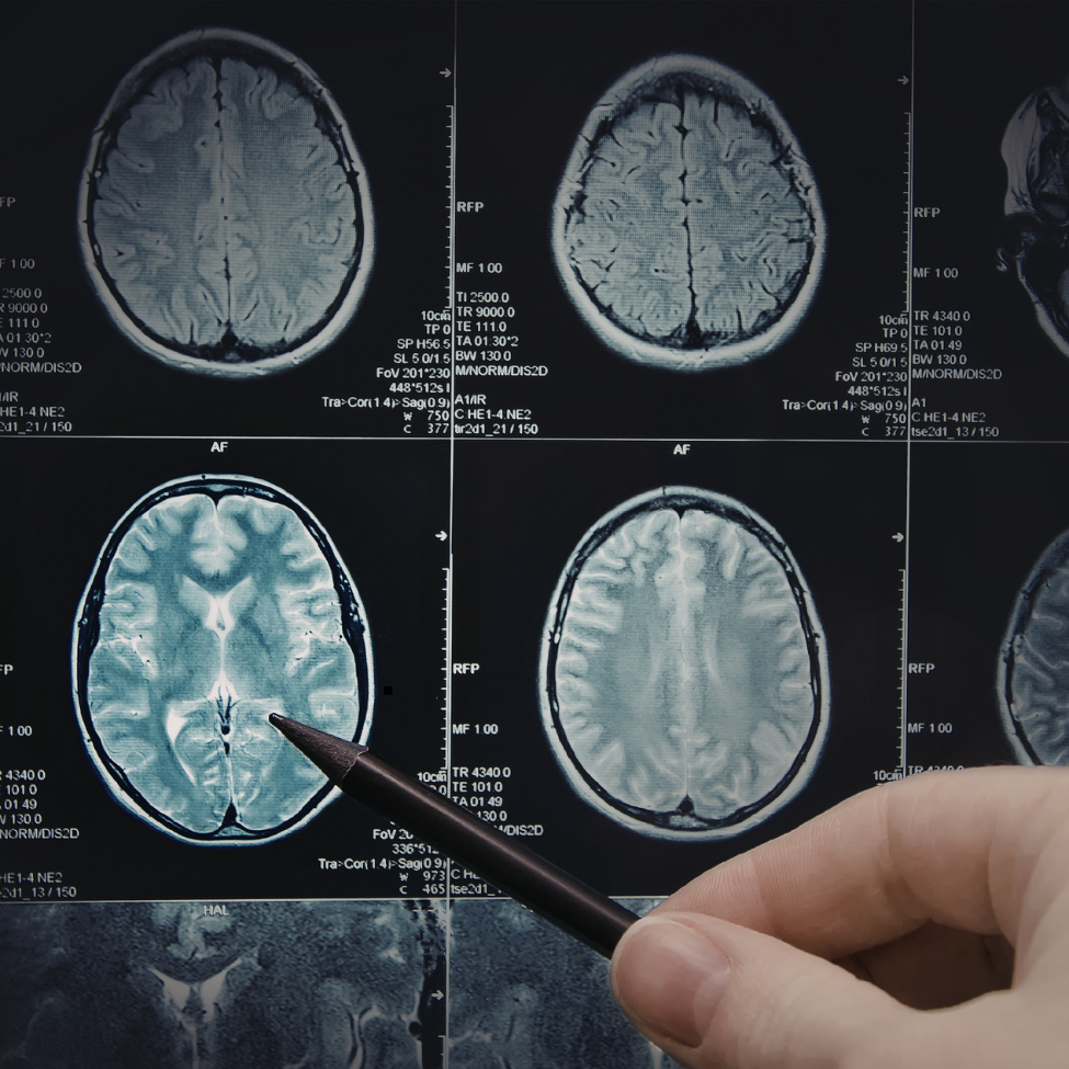 MRI Scan for Back Pain