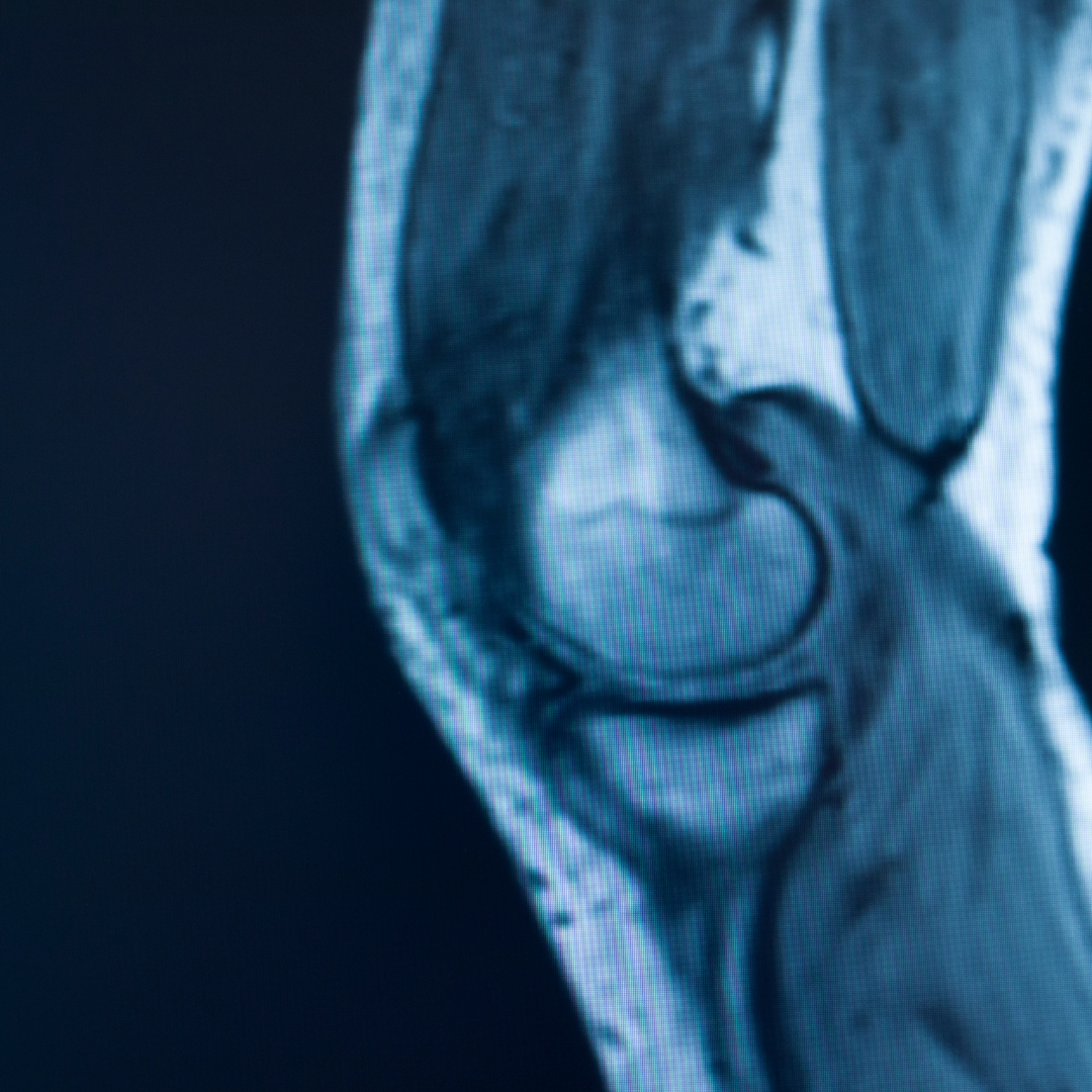 Private MRI scanning for sports injuries