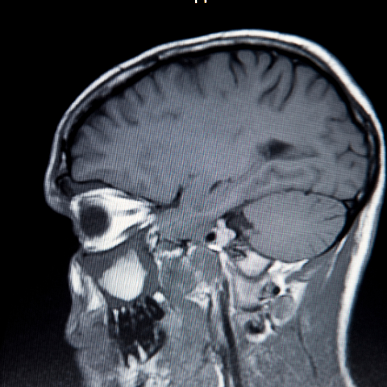 MRI scan showing a sagittal view of the brain
