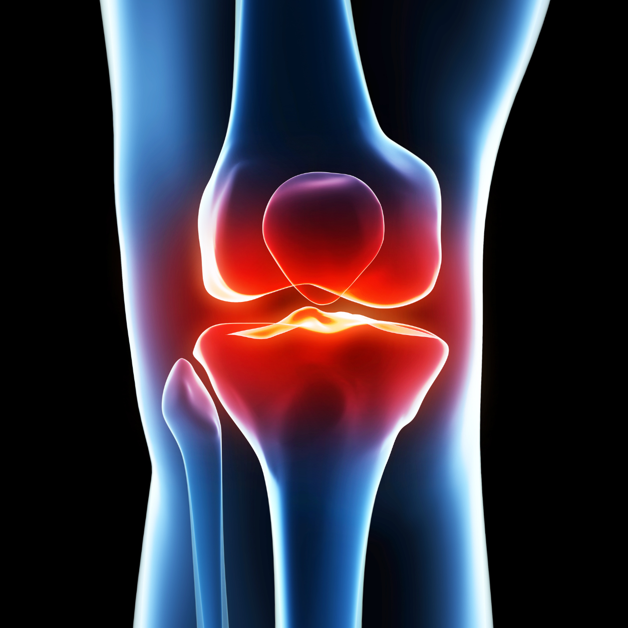 Illustration showing the internal structures of a painful knee joint relevant to knee MRI imaging