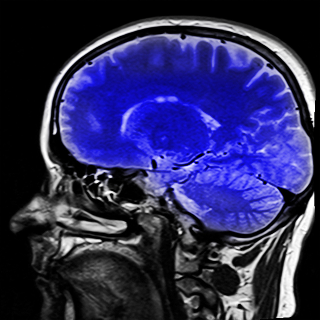 Sagittal brain MRI image for private brain MRI in Leeds