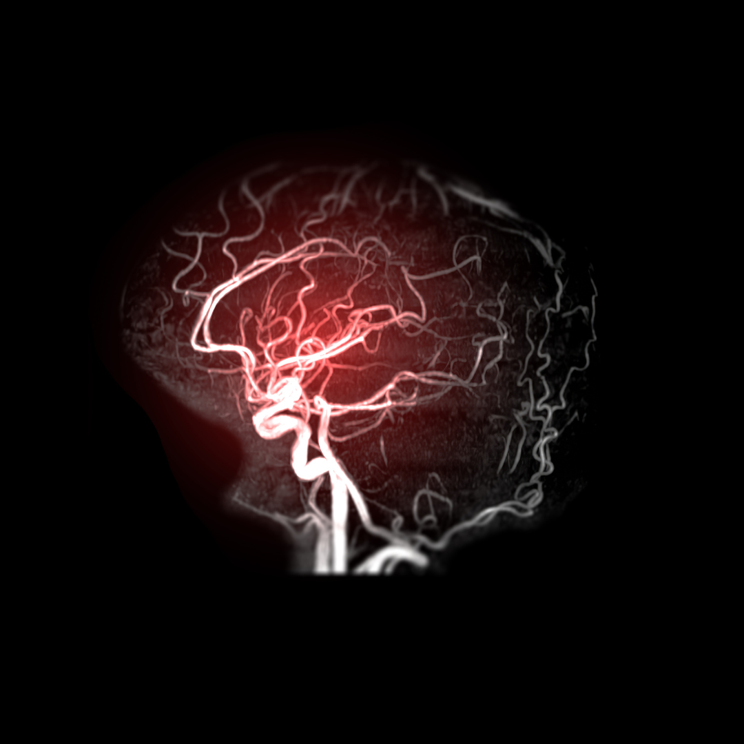 Cerebral blood vessel imaging used to explain Brain MRA and MR venography
