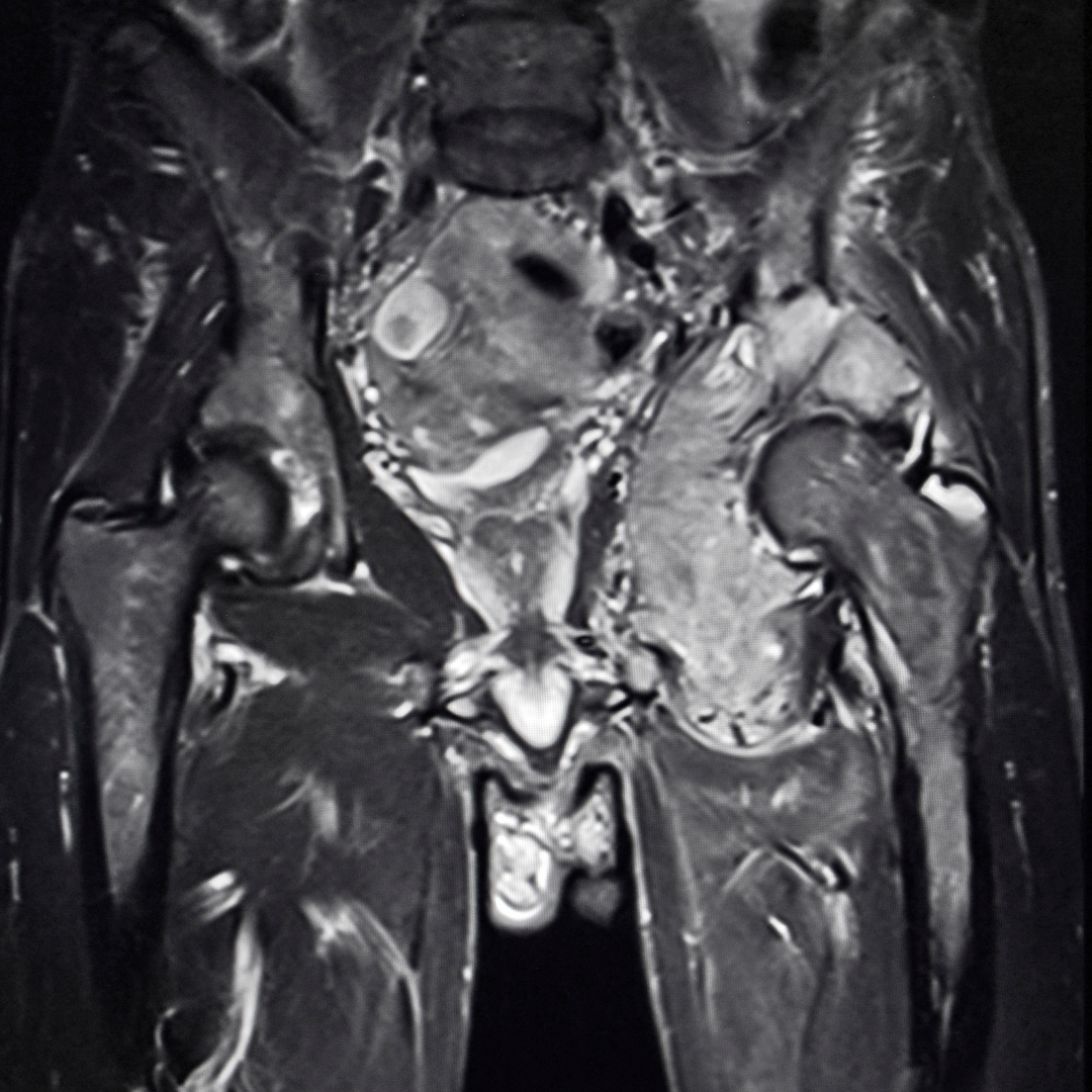 mri hip scan in leeds