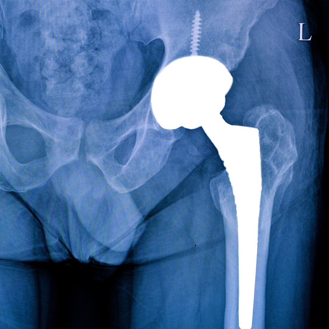 Orthopaedic implants such as hip replacements are usually safe for MRI