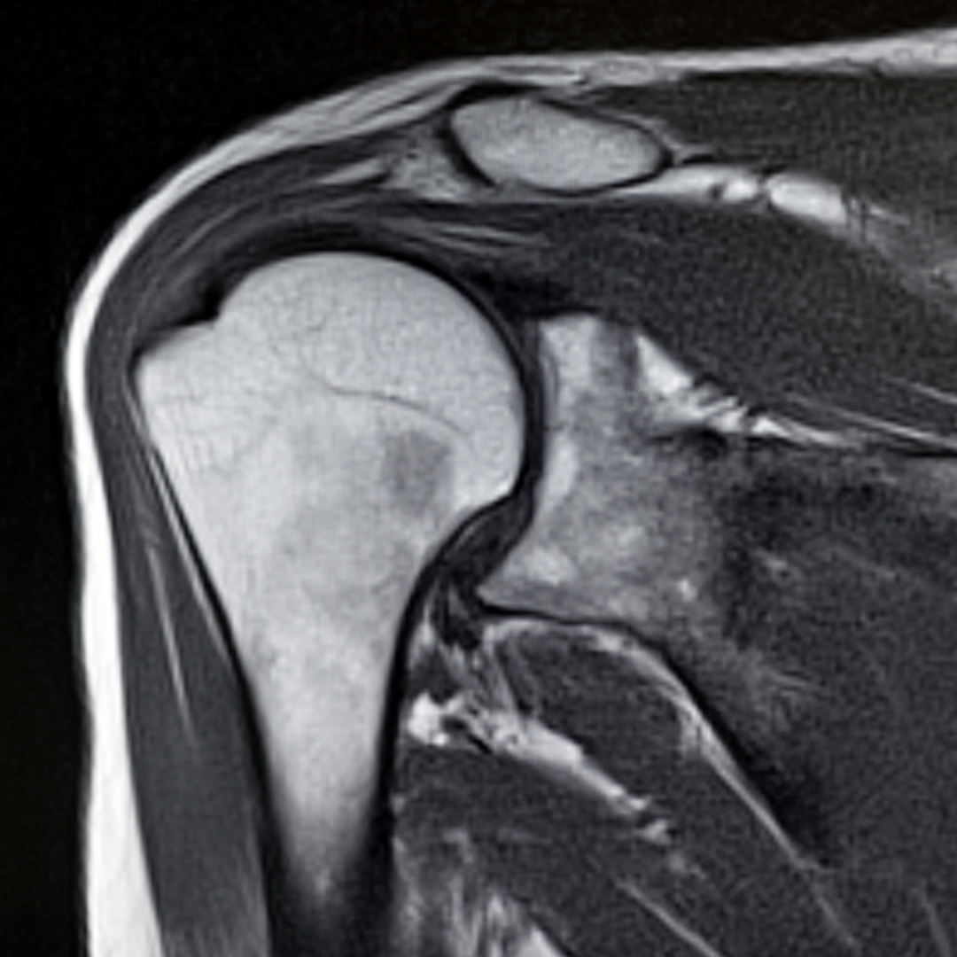 MRI image of the rotator cuff tendons of the shoulder